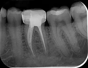 Retaining teeth or removing