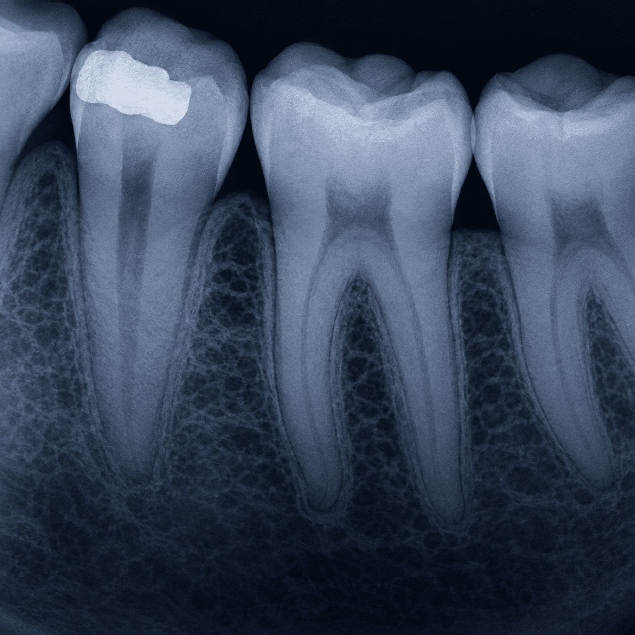 Periapical radiograph